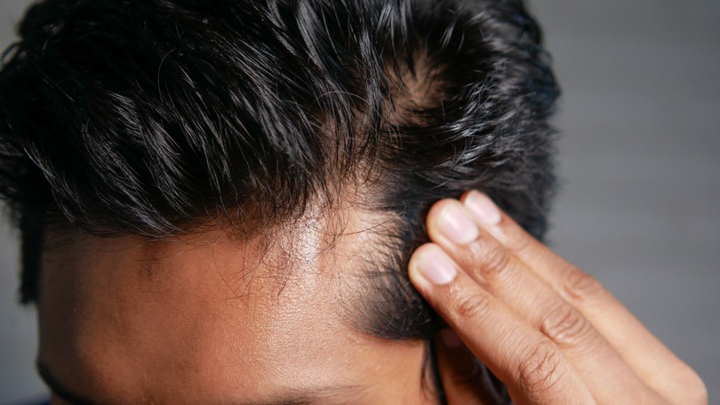 Hair Loss Article